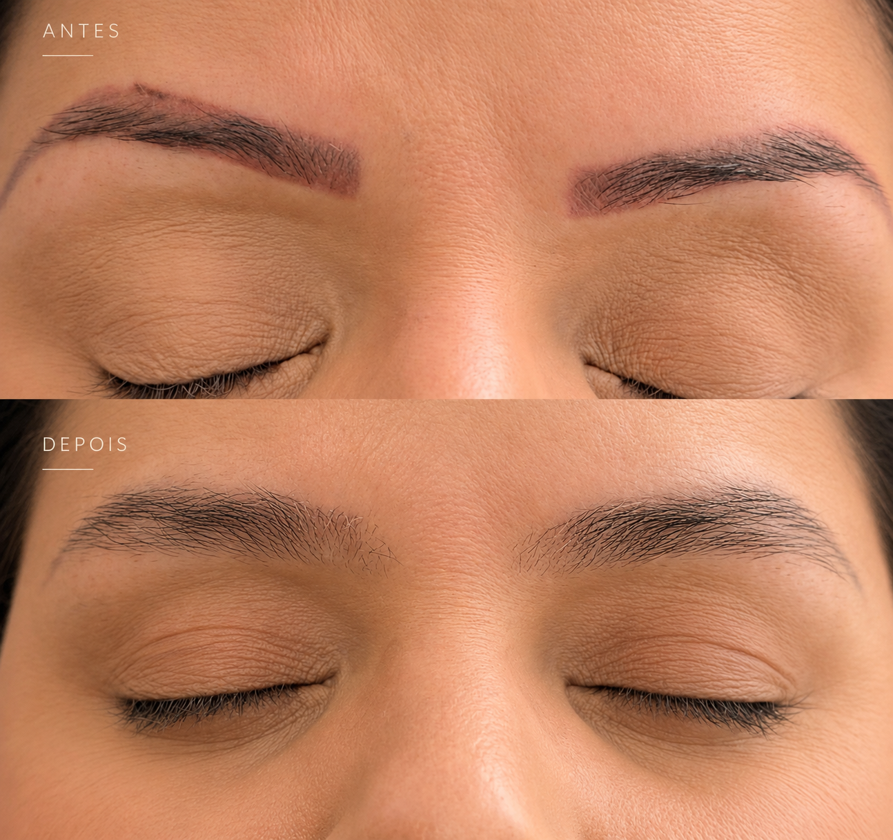 Antes e depois de remoção a laser de micropigmentação com reconstrução das sobrancelhas